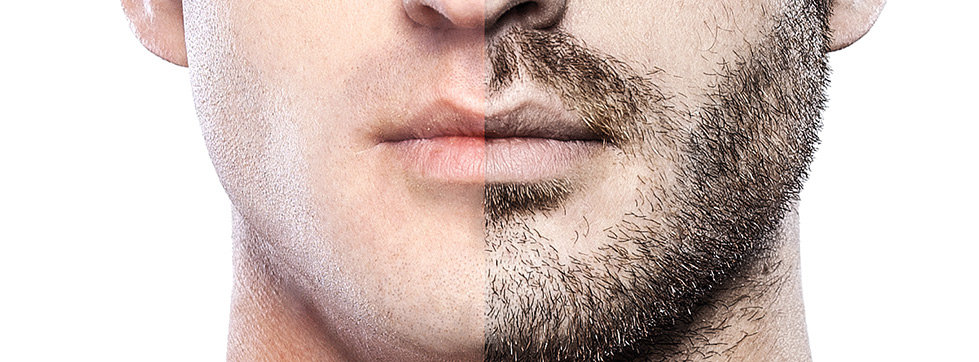 beard-transplant-زراعة-اللحية-2